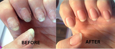 Lanvara™ Nail Rescue Pen